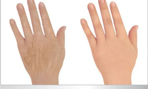 Tiêm filler làm đầy bàn tay và những ưu điểm không thể phủ nhận