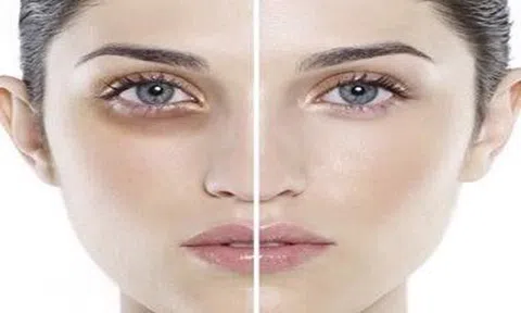 Tiêm filler thâm mắt và trũng mắt - bạn có tin không?