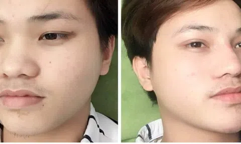Tiêm filler thu gọn cánh mũi và những điều cần biết