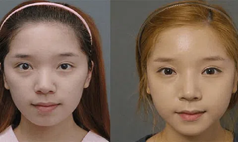 Làm đầy má hóp có đau không? Có nguy hiểm không?