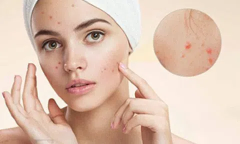 Mụn Trứng cá- Nỗi ám ảnh vì làn da xấu xí