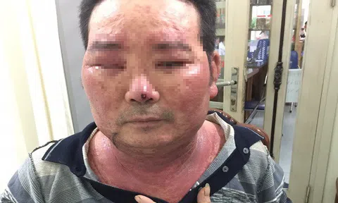 Hậu họa khi tiêm thuốc 'thần dược' điều trị viêm da