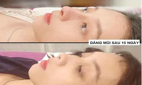 Nâng mũi bằng Filler không đáng sợ - Đáng sợ ở 'người tiêm' và Filler 'dỏm'