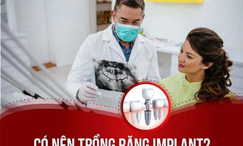 Giải đáp từ bác sĩ: Có nên trồng răng Implant?