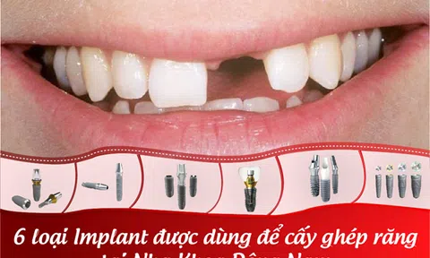 6 loại Implant được dùng để cấy ghép răng hiện nay