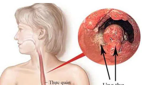 Chuyên gia chỉ cách cải thiện trào ngược dạ dày bằng nước uống tốt