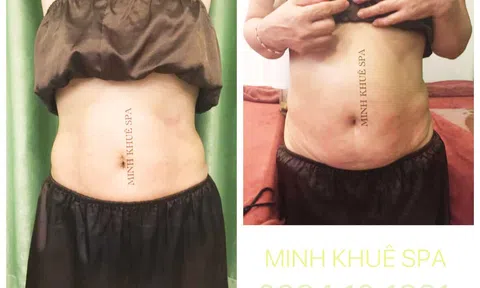Phương pháp giảm mỡ bụng nhanh chóng, hiệu quả, đảm bảo mỡ thừa không quay lại