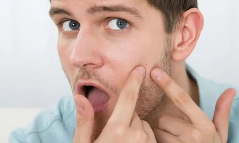 Mách bạn 6 thói quen xấu khiến nam giới bị mụn hoành hành