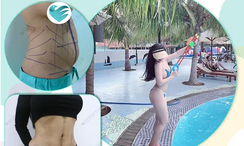 Hút mỡ bụng uy tín và những lưu ý cần biết