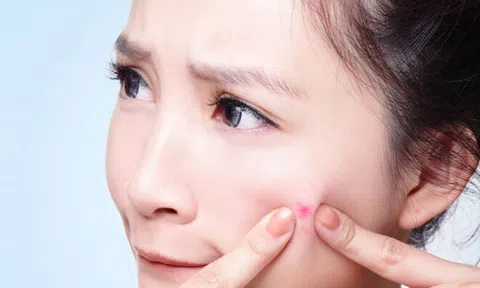 Làm thế nào để nặn mụn không để lại sẹo thâm?
