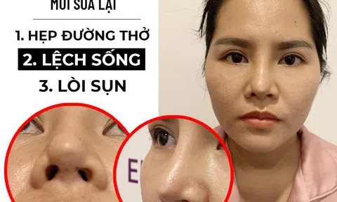 Không tìm hiểu kỹ địa điểm thẩm mỹ, nhiều chị em phải sửa mũi đến lần thứ 5