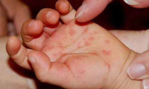 Bộ Y tế: Thực hiện ngay "3 sạch" để phòng chống bệnh tay chân miệng