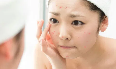 Cấp cứu da mặt đột nhiên bị ngứa và nổi mụn