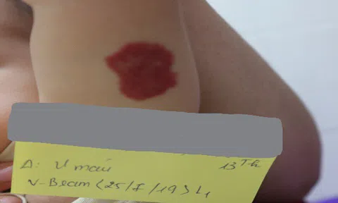 Bệnh u máu có nguy hiểm không?