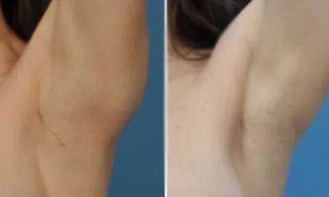 Nâng ngực có đau và để lại sẹo không?