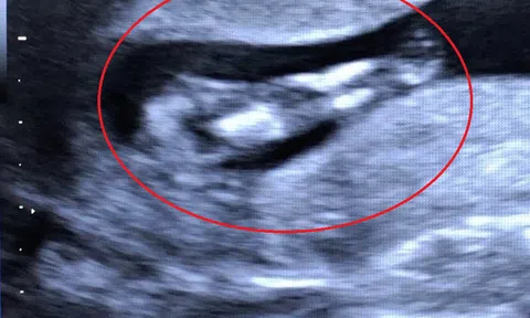 TP. Cần Thơ: Hy hữu chẩn đoán hình ảnh phát hiện thai nhi mắc hội chứng người cá