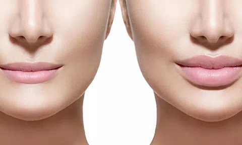 Tiêm filler có tốt không? Có hiệu quả không?
