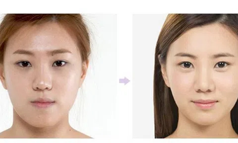 Tiêm filler dưới mắt tạo bọng mắt quyến rũ – Tại sao không?