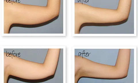 Tiêm filler giảm mỡ bắp tay – Liệu có hiệu quả không?
