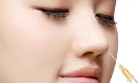 Tiêm filler nhân trung và lời cảnh tỉnh cho các chị em