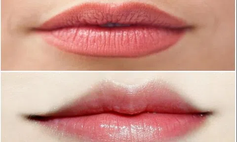 Tiêm filler môi dày thành môi mỏng, môi trái tim có an toàn không?