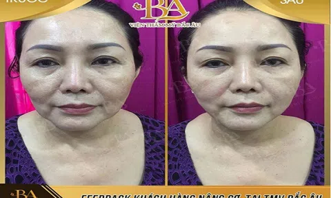 Già nhưng cũng phải trẻ đẹp: Chia sẻ của cô Hà khi nâng cơ trẻ hóa tại thẩm mỹ viện Bắc Âu