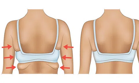 Công nghệ giảm mỡ vai và bắp tay số 1 Hoa Kỳ tại Thẩm mỹ viện Bắc Mỹ Thanh Hóa