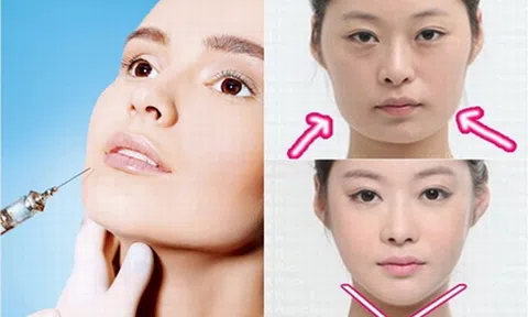 Tiêm filler nhỏ mặt – ưu điểm hay những biến chứng không lường trước?