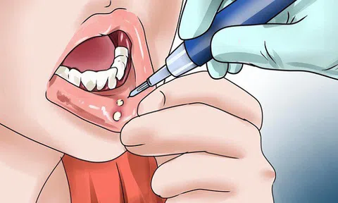 Những tác nhân gây nhiệt miệng