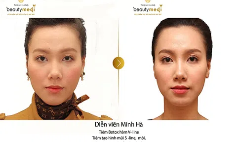 Kỳ tích thẩm mỹ, nâng mũi không phẫu thuật, đẹp tự nhiên chỉ sau 5 phút