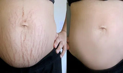 Điều trị rạn da an toàn không đau, không xâm lấn da tại Thẩm mỹ viện quốc tế Bắc Âu
