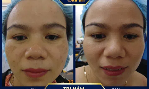 Multi Picosure Extra 2020 - Công nghệ trị nám tận gốc tiên tiến nhất năm 2020 tại Thẩm mỹ viện Bắc Mỹ