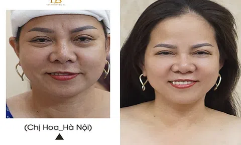 Off 50% công nghệ Ultherapy: Nâng cơ mặt - Da săn chắc - Không cần phẫu thuật