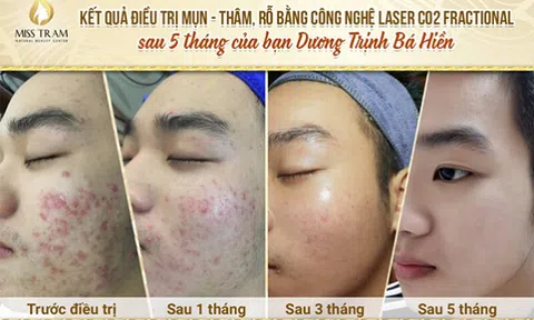 Top các sai lầm khi trị mụn cần nhớ