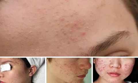 Nguyên nhân hình thành và phương pháp điều trị mụn trứng cá