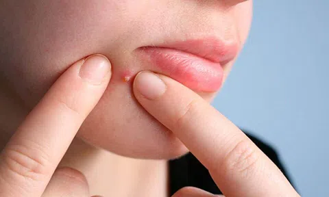 Làm thế nào để giảm sưng sau khi nặn mụn?