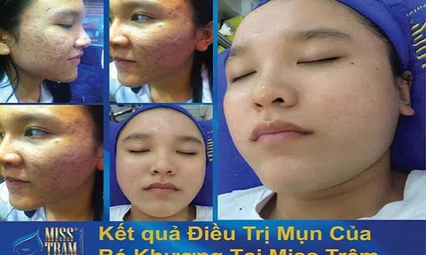 Top 10 loại trái cây rất tốt cho da mụn