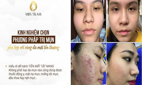 Cách nặn mụn bọc, mụn mủ an toàn tại nhà
