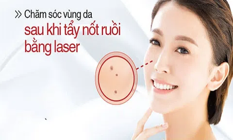 Hướng dẫn chăm sóc da sau khi tẩy nốt ruồi bằng Laser