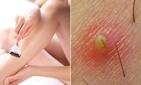 Cách trị viêm lỗ chân lông ngay tại nhà