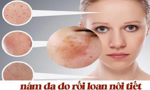 Phân biệt nám nội tiết tố và nám môi trường. Đâu là giải pháp trị nám hiệu quả
