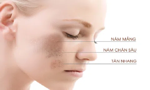 Tàn nhang nám cũng phải 'chào thua' khi bạn dùng tuyệt chiêu này