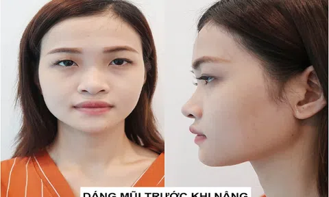Nhờ nâng mũi phong thủy - Cô nàng 'Ẵm ngay' danh hiệu nữ hoàng quyến rũ