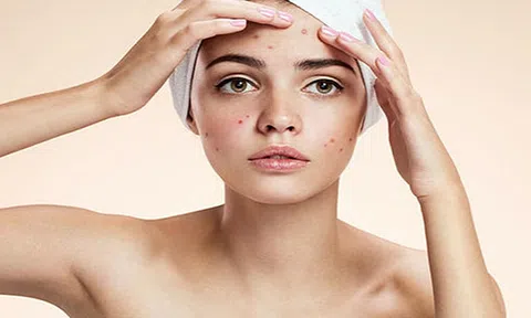 Thiết lập chế độ ăn uống sinh hoạt cho người bị mụn