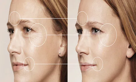 Tại sao bạn nên can thiệp da lão hóa bằng công nghệ Thermage?