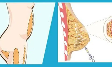 Tìm hiểu phương pháp nâng ngực chảy xệ không cần phẫu thuật