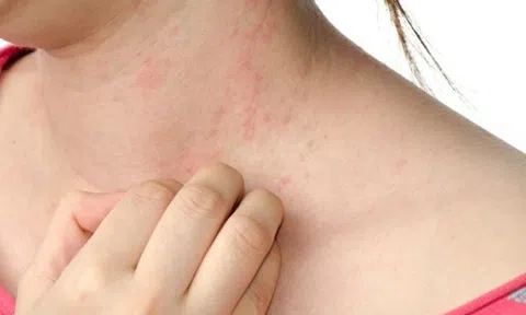 Bác sĩ da liễu cảnh báo các vấn đề về da thường xuyên gặp phải vào mùa hè
