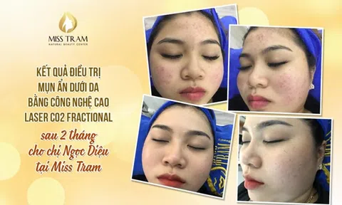 Cách làm mặt nạ lột mụn đầu đen hiệu quả tại nhà