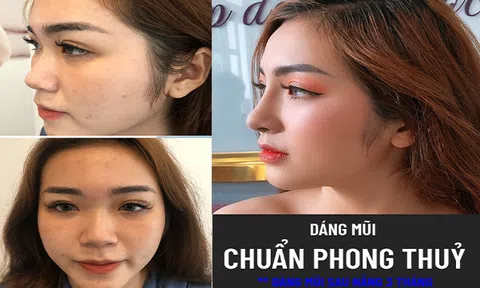 Nâng mũi phong thủy theo góc nhìn từ Ths. Bác sỹ Trần Quang Long