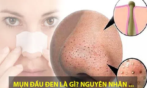 Hiểu rõ về mụn đầu đen và cách chăm sóc hiệu quả